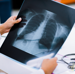 Chest X-Ray