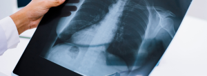 Chest X-Ray